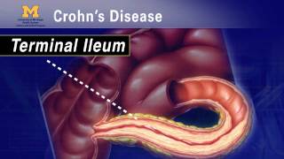 IBD School 102  What is Crohns Disease [upl. by Norrad]