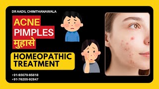 मुहासे  Acne  PIMPLES  Best Homeopathic Treatment  Dr Aadil Chimthanawala  Skin Complaints [upl. by Valente621]