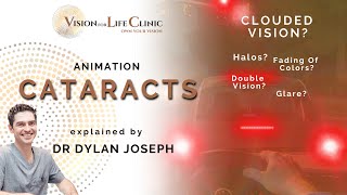 How Do Cataracts Affect Your Vision  Animation explained by Dr Dylan Joseph [upl. by Furmark]