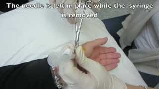 MCP Injection of the Left Thumb  Metacarpophalangeal Joint [upl. by Tips]