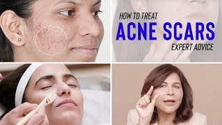 Treatments for ACNE SCARS  Dr Bindus Expert Advice [upl. by Nnaihs]