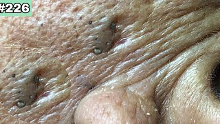 Get rid of blackheads 30 years in ears 226  BYoung Spa Quyet Hair 2 [upl. by Airehs591]