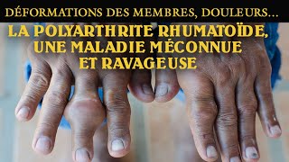 Déformations des membres douleurs…  La polyarthrite rhumatoïde une maladie méconnue et ravageuse [upl. by Dorena]