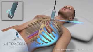 How to obtain Parasternal Short Axis Ultrasound View  Training and Techniques  ICU [upl. by Bridgid864]