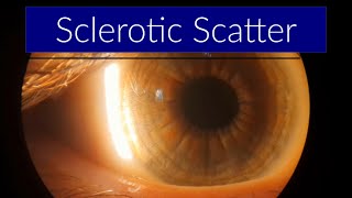 Sclerotic Scatter  Slit Lamp Techniques [upl. by Sup]