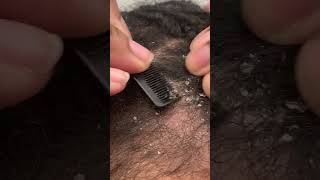 Itchy Dry Scalp  Dandruff Picking ASMR [upl. by Peppi]