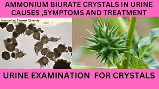 AMMONIUM BIURATE CRYSTALS IN URINECAUSES SYMPTOMS AND TREATMENT OF AMMONIUM BIURATE [upl. by Gratia]