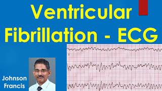 Ventricular Fibrillation ECG [upl. by Urbano]