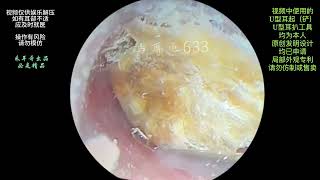 采耳哥The ear canal is blocked by large pieces of fungal earwax for cleaning [upl. by Notslar59]