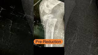 Close reduction of proximal epiphyseal slip of tibia in kids  SALTERHARRIS type 1 [upl. by Padriac]