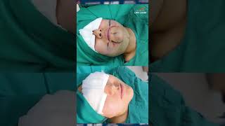 Increíble resultado de una LIPOPAPADA  BICHECTOMÍA Antes y después  Lipoylaser Perú [upl. by Calva]