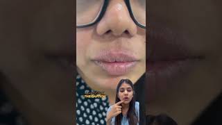 Lip licker’s dermatitis treatment  liplickersdermatitis liplicking shorts youtubeshorts [upl. by Collar339]