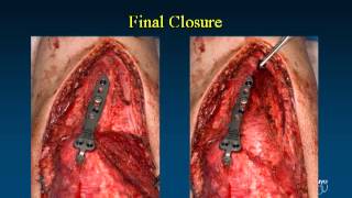 Fixation Options and Techniques for Distal Humerus Fractures VuMedi [upl. by Beulah]