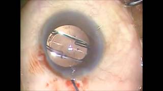 enVista intraocular lens by Bausch amp Lomb Insertion VideoOctober 29 2012 by Jeffrey Whitman MD [upl. by Buyse]