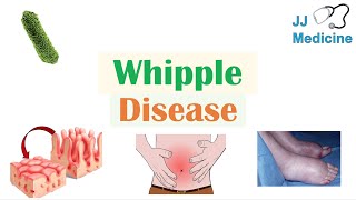 Whipple Disease  Causes Risk Factors Pathophysiology Symptoms Diagnosis Treatment [upl. by Eramat]