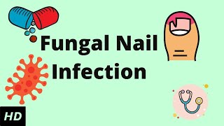 Fungal Nail Infection Causes Signs and Symptoms Diagnosis and Treatment [upl. by Goodill]