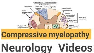 Compressive myelopathy  Neurology videos learn by seeing [upl. by Chenay]