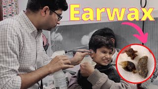 Earwax Removal from children  How to remove hard wax from small children  Video otoscaopy [upl. by Abixah]