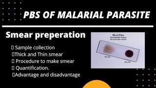 Laboratory diagnosis of malaria  PBS malaria  malaria parasites under microscope [upl. by Gunning975]