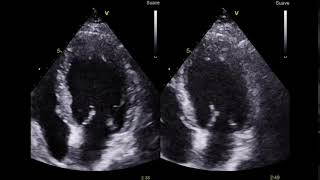Video 1  Ecocardiograma de estrés  Proyección 4 cámaras [upl. by Corabel]