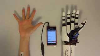 handiii accessible myoelectric hand prosthesis [upl. by Eilrak]