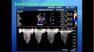 Elementi di ecocardiografia IX video valvulopatia tricuspidalica [upl. by Kraul]