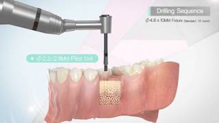 DENTIS Implant DIK Kit Drilling Sequence [upl. by Schwerin]