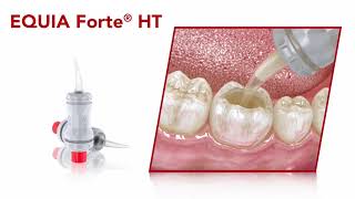 EQUIA Forte® HT  Restoration Guide [upl. by Toland713]