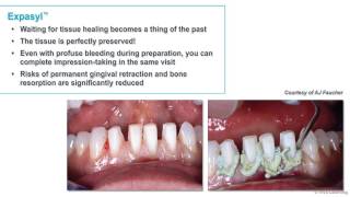 Expasyl  A perfect process for gingival retraction [upl. by Hadleigh531]