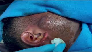 FACE ABSCESS  An immediate improvement after pus aspiration  Needle aspiration [upl. by Nirtak]