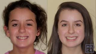 Before and after for severe crowding without extractions Traditional Braces [upl. by Nole489]