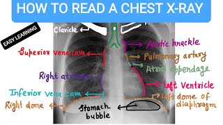 How To Read A Chest Xray [upl. by Goody878]