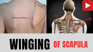 WINGING Of SCAPULACausesTreatmentwinging scapula causes treatment anatomy demage nerve yt [upl. by Dlonyer259]