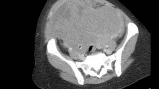 CT Abdomen amp Pelvis w HUGE Fibroid Uterus DISCUSSION by a Radiologist [upl. by Annabelle641]