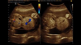 Omphalocele and Bilobed Placenta [upl. by Ailemrac918]