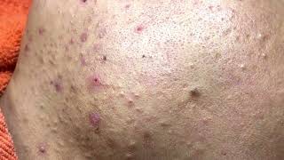 Loan Nguyen Acne Treatment 4c [upl. by Inigo]