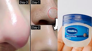 How to remove blackheads and Whiteheads from nose and face naturally at home [upl. by Diella]