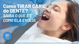 Como TIRAR CÁRIE do DENTE Saiba o que é e como ela evolui [upl. by Elleinet669]