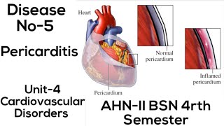 PericarditisDisease No5Unit4Cardiovascular DisordersAHNIIBSN 4rth semesterIn UrduEng [upl. by Takeshi]