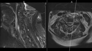 Spinal epidural abscess is easy to miss T1 images are key [upl. by Adnwahsat283]