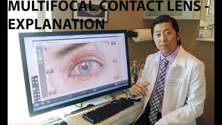 What is a multifocal lens IOL [upl. by Porett554]