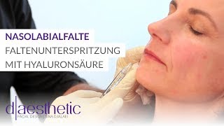 Nasolabialfalte  Faltenunterspritzung mit Hyaluronsäure  daesthetic [upl. by Akemet]