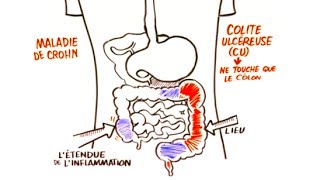 Maladie Inflammatoire de Lintestin MII [upl. by Bertine]