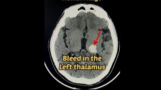 Hypertensive Intraparanchymal hemorrhage  Brain 🧠 bleed 🩸 Radiology hemorrhage brain [upl. by Nednarb]