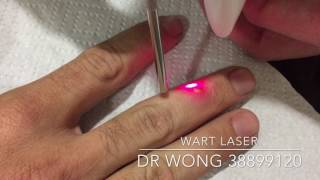 Laser to get rid of warts on Finger [upl. by Josepha]