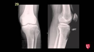 Radiology Boards Prep  MSK Cases [upl. by Tergram]