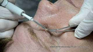 Soft fibroma  removal by highfrequency electrosurgery [upl. by Rubio947]