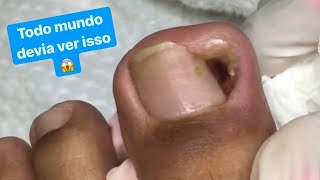 UNHA ENCRAVADA COM GRANULOMA ACENTUADO😰 Podologia manicure Kelly Freitas [upl. by Eerdua902]