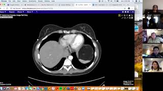 Large retroperitoneal mass  Aarti Sekhar  Liposarcoma [upl. by Ahseat453]