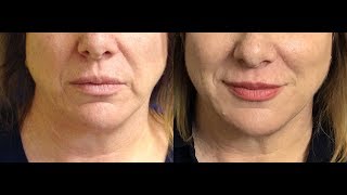 How to Get Rid of Vertical Lip Lines Bye Bye Smoker Lines [upl. by Inoliel]